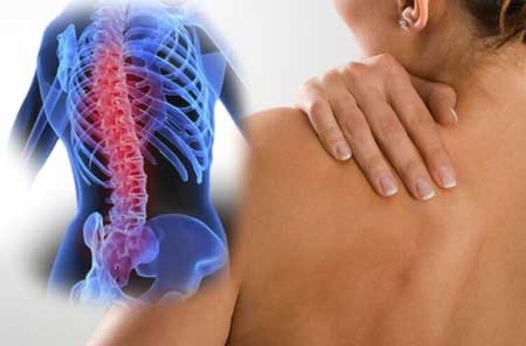 Avec l'ostéochondrose, la douleur peut irradier vers des zones éloignées du corps