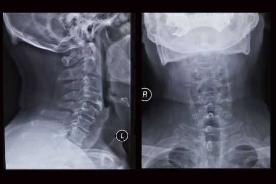 Radiographie de la colonne cervicale (le patient souffre d'ostéochondrose)
