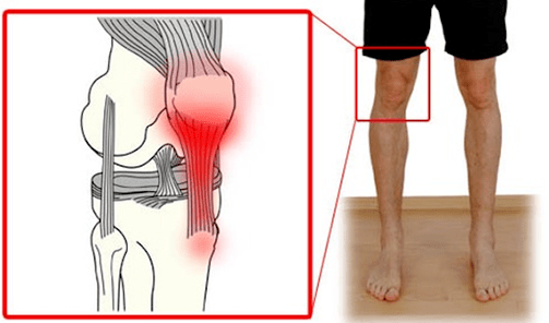 La tendinite est une inflammation du tissu tendineux qui provoque des douleurs dans l'articulation du genou. 