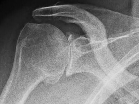 Radiographie d'une articulation de l'épaule affectée par l'arthrose