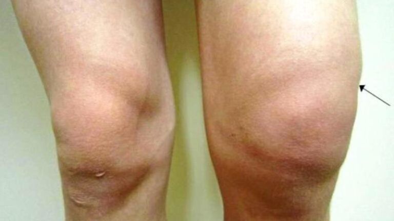 Symptômes d'arthrose