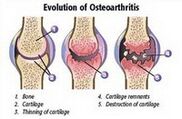 Stades d'arthrose