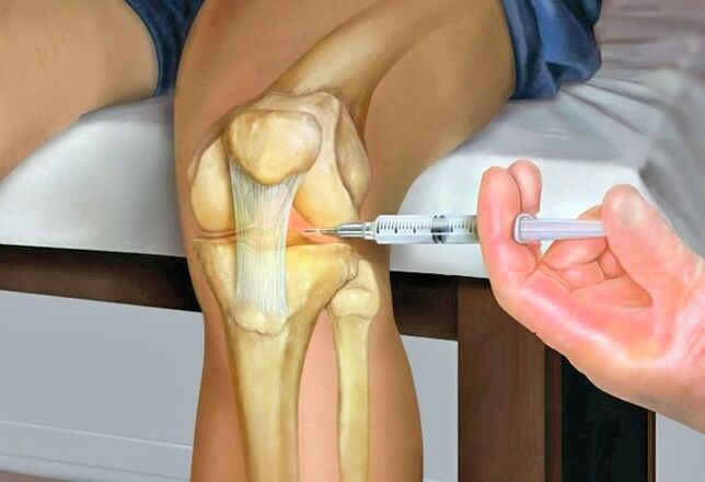 Traitement de l'arthrose de l'articulation du genou