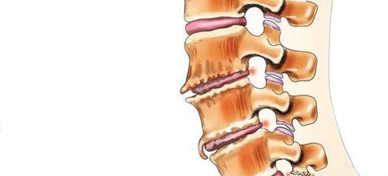 Spondylose - destruction des articulations pivotantes intermédiaires