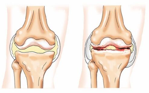 Articulations saines et arthrose
