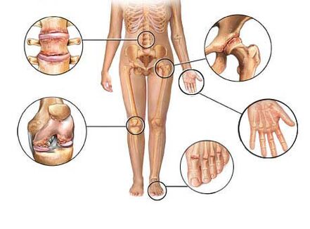 L'arthrose touche diverses articulations
