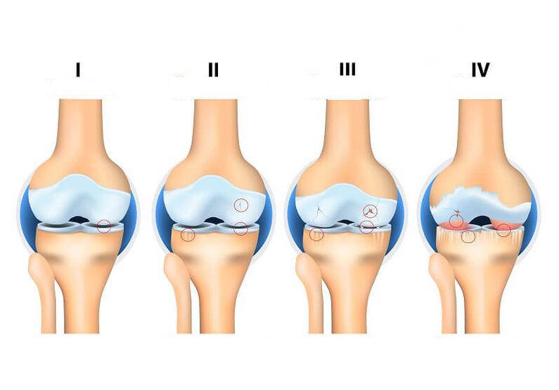 Stades de l'arthrose articulaire