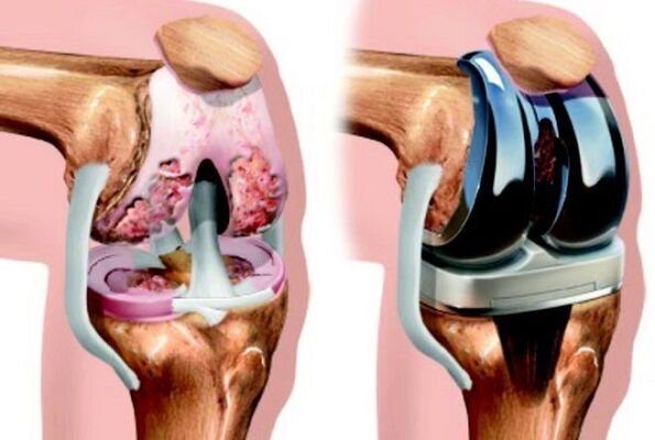 avant et après l'arthrose de l'articulation du genou dans l'arthrose