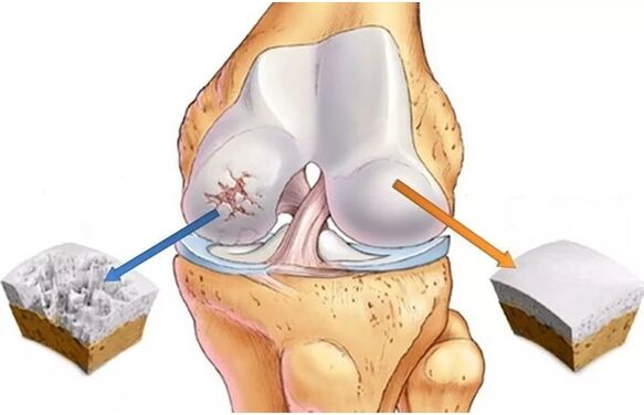 cartilage et cartilage sains affectés par l'arthrose